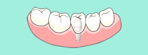 STEP 3.人工歯取り付け