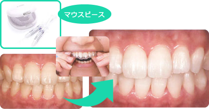 ホワイトニングで歯を白く自然な透明感にすることができます