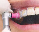 STEP1.ホワイトニングのご説明＆歯の表面をクリーニング